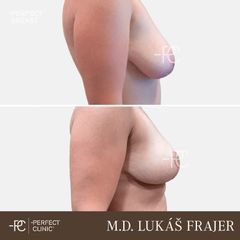 Modelace prsou - Perfect Clinic - centrum estetické medicíny