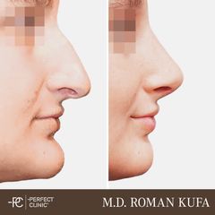 Rhinoplastika - Perfect Clinic - centrum estetické medicíny
