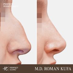 Rhinoplastika - Perfect Clinic - centrum estetické medicíny