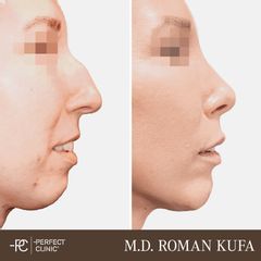 Rhinoplastika - Perfect Clinic - centrum estetické medicíny
