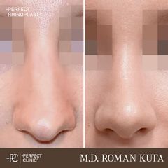 Rhinoplastika - Perfect Clinic - centrum estetické medicíny