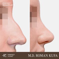 Rhinoplastika - Perfect Clinic - centrum estetické medicíny