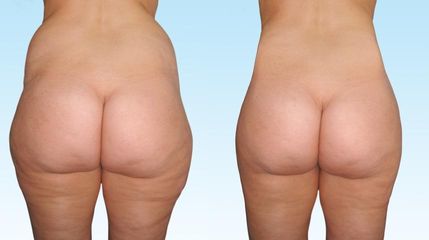 lipo2