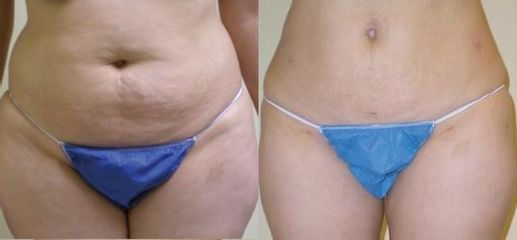 Hirnak laserova lipo