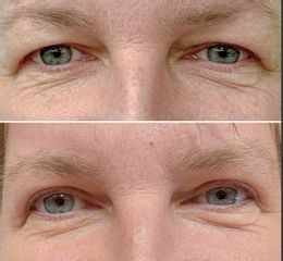 Operace očních víček - BESTÉE clinic