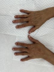 Omlazení rukou - BESTÉE clinic
