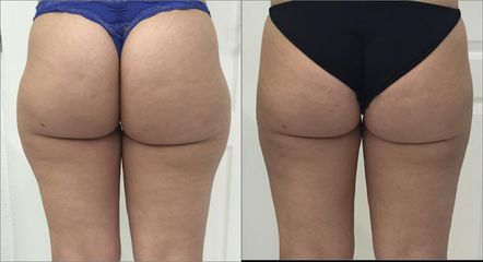 Liposukce tumescentní