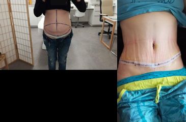 Lipoabdominoplastika