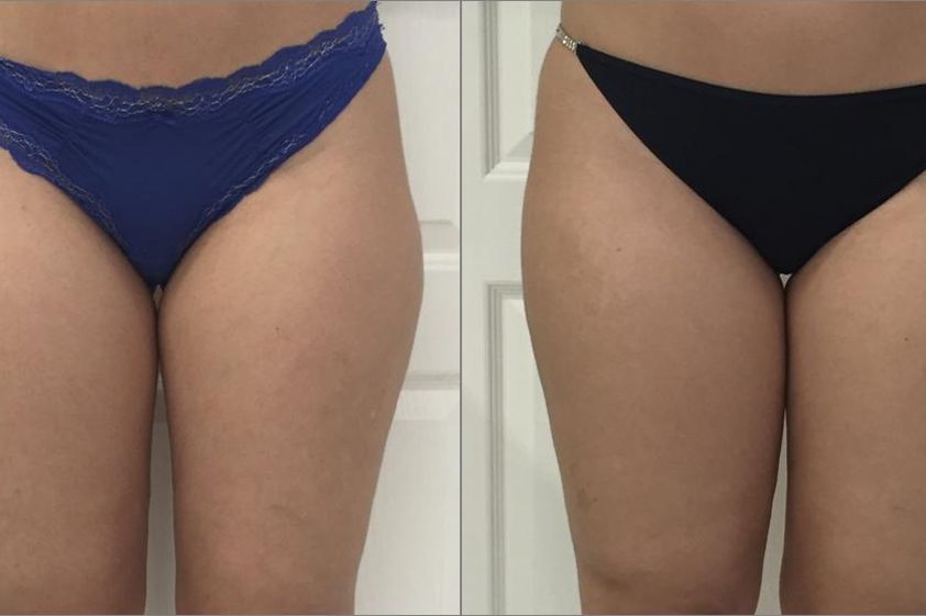 Neinvazivní liposukce před a po - 731752