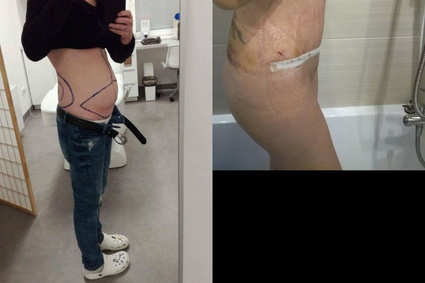 Abdominoplastika před a po - 731754