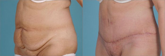 Abdominoplastika a liposukce boků.