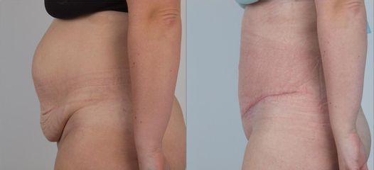 Abdominoplastika