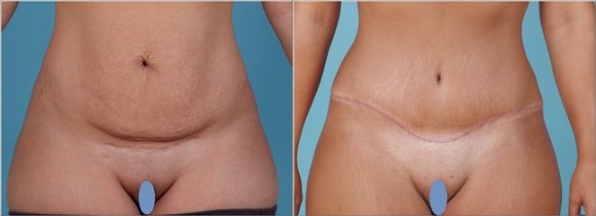 Abdominoplastika