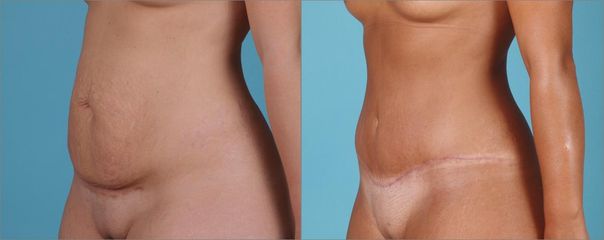 Abdominoplastika