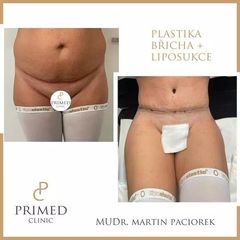 plastika bricha MUDr. Martin Paciorek