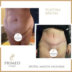Abdominoplastika - MUDr. Martin Paciorek