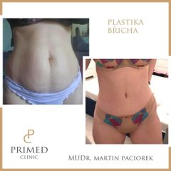 Abdominoplastika - MUDr. Martin Paciorek