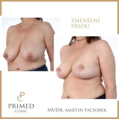 Zmenšení prsou - MUDr. Martin Paciorek