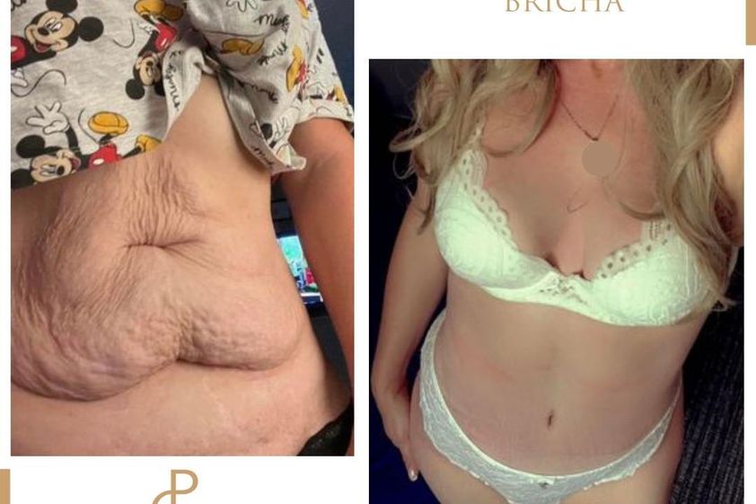 Abdominoplastika před a po - 858841