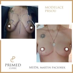 Modelace prsou - MUDr. Martin Paciorek