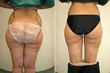 liposukce