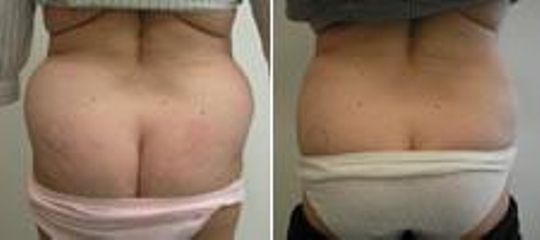 liposukce 3