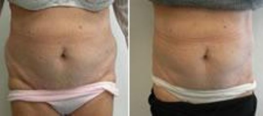 liposukce 4