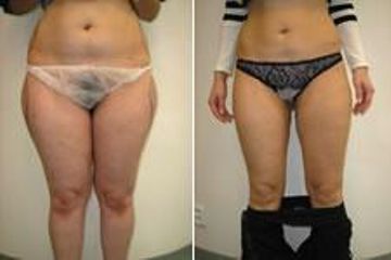 liposukce 5
