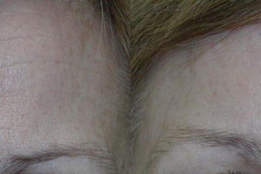 Brow lift před a po - 721229