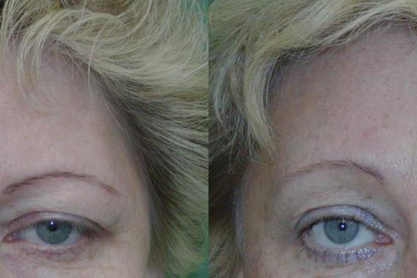 Brow lift před a po - 721243