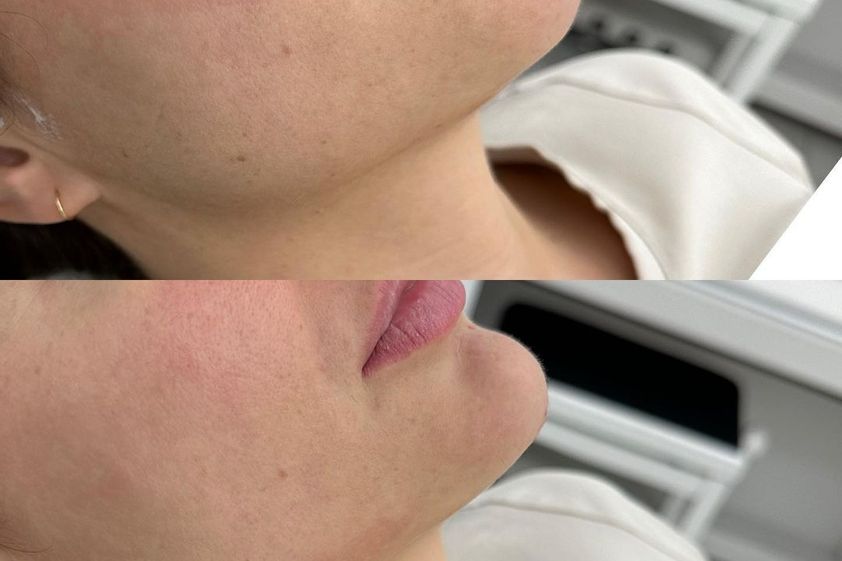 Injekční výplně před a po - 859556