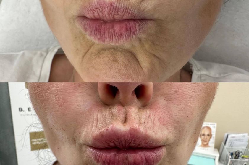 Botulotoxin před a po - 859559