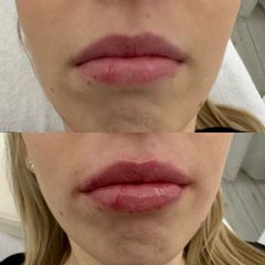 Zvětšení rtů kyselinou hyaluronovou - MUDr. Jana Šimurdová