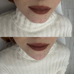 Kyselina hyaluronová - MUDr. Jana Šimurdová