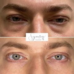 Operace očních víček - MUDr. Elbek Rashidov - Signature Clinic