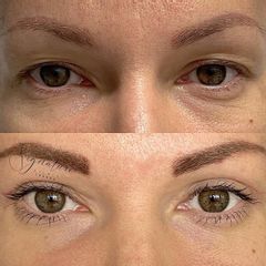 Operace očních víček - MUDr. Elbek Rashidov - Signature Clinic