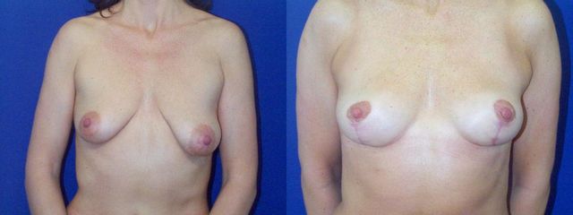c 1 pred plastikou s asymetrii i