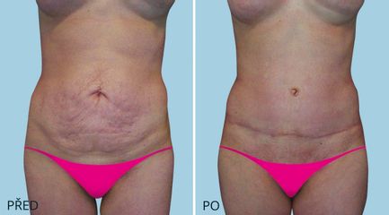 ABDIMINOPLASTIKA 1387 1