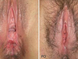 Vaginoplastika před a po - 716425