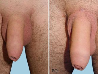 Zvětšení penisu před a po - 716428