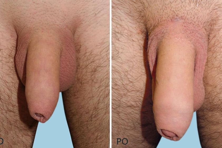 Zvětšení penisu před a po - 716428