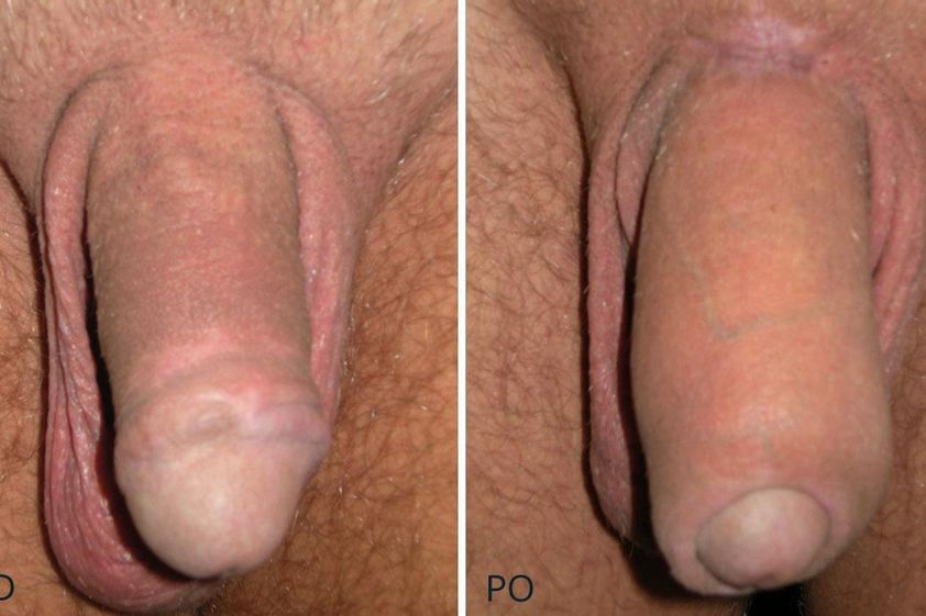 Zvětšení penisu před a po - 716429