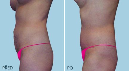 ABDIMINOPLASTIKA 1387 2