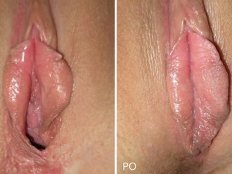 Vaginoplastika před a po - 716449