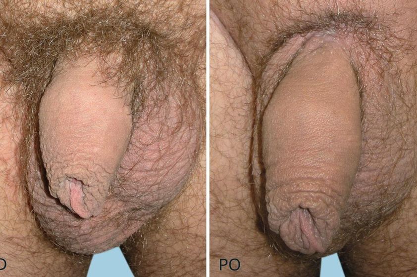 Zvětšení penisu před a po - 716452