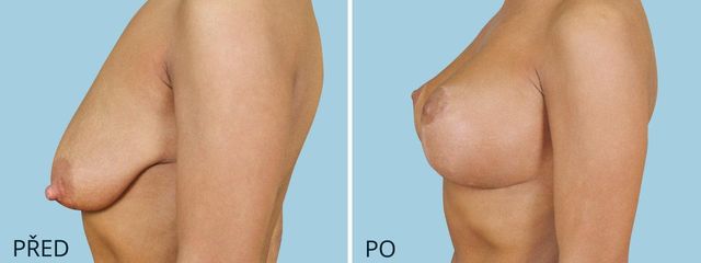 plastika povislych prsou modelace zvetseni 2 2