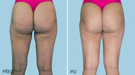 LIPOSUKCE 0023 2