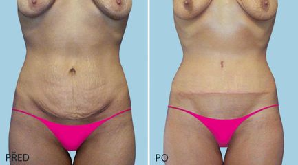 ABDIMINOPLASTIKA 2138 1