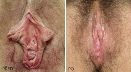 LABIO 1049