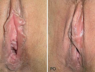 Vaginoplastika před a po - 716469